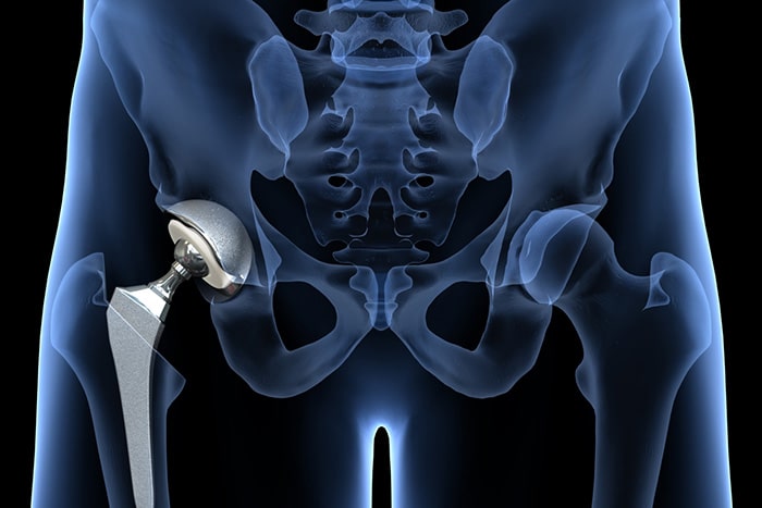 1760654282 hip replacement 1 Full Hip Replacement: Do I Need One?